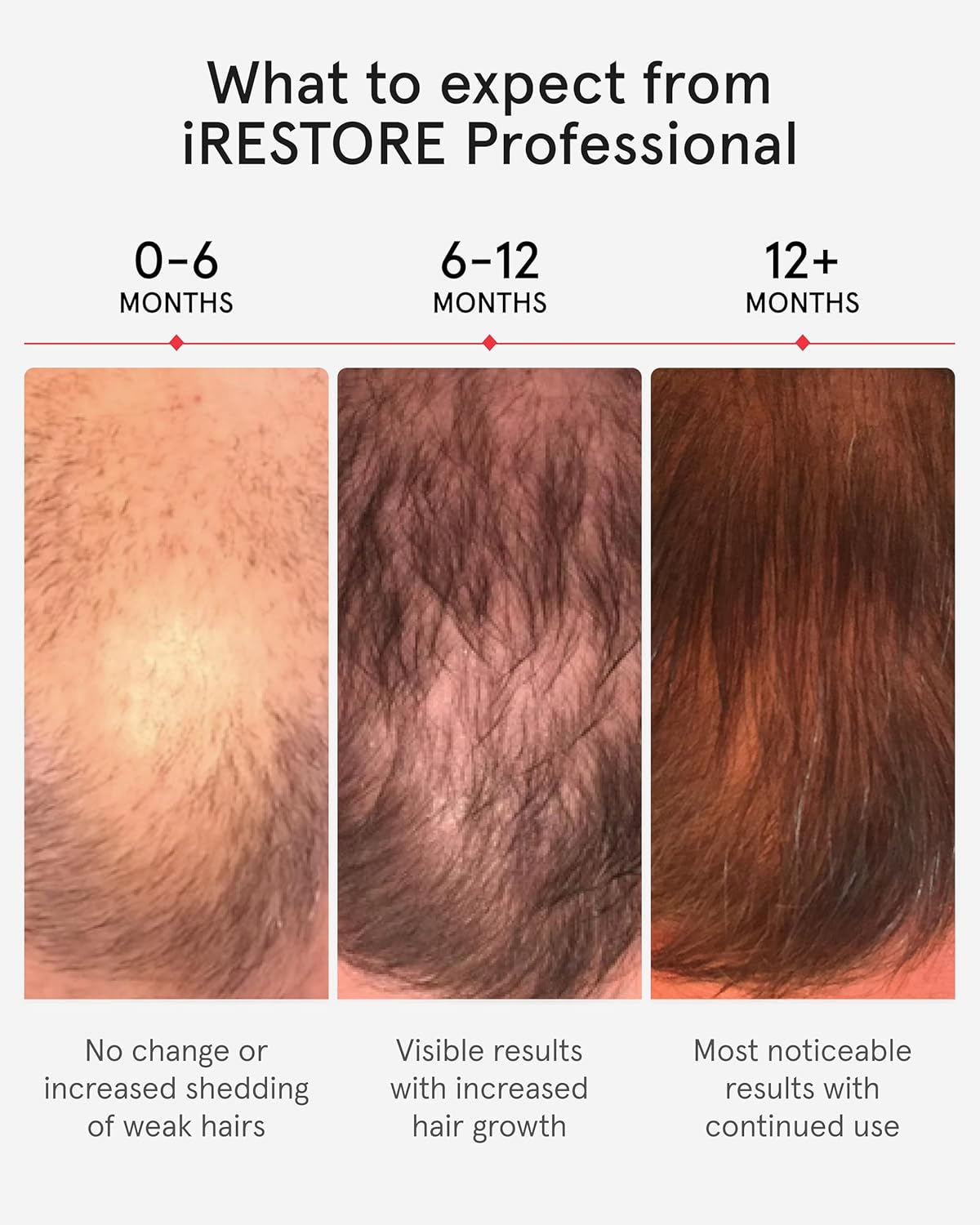 iRestore Professional Laser Red Light Therapy for Hair Growth System - FDA Cleared Hair Loss, Hair Thinning & Alopecia Treatment for Men & Women - 282 Lasers & LEDs