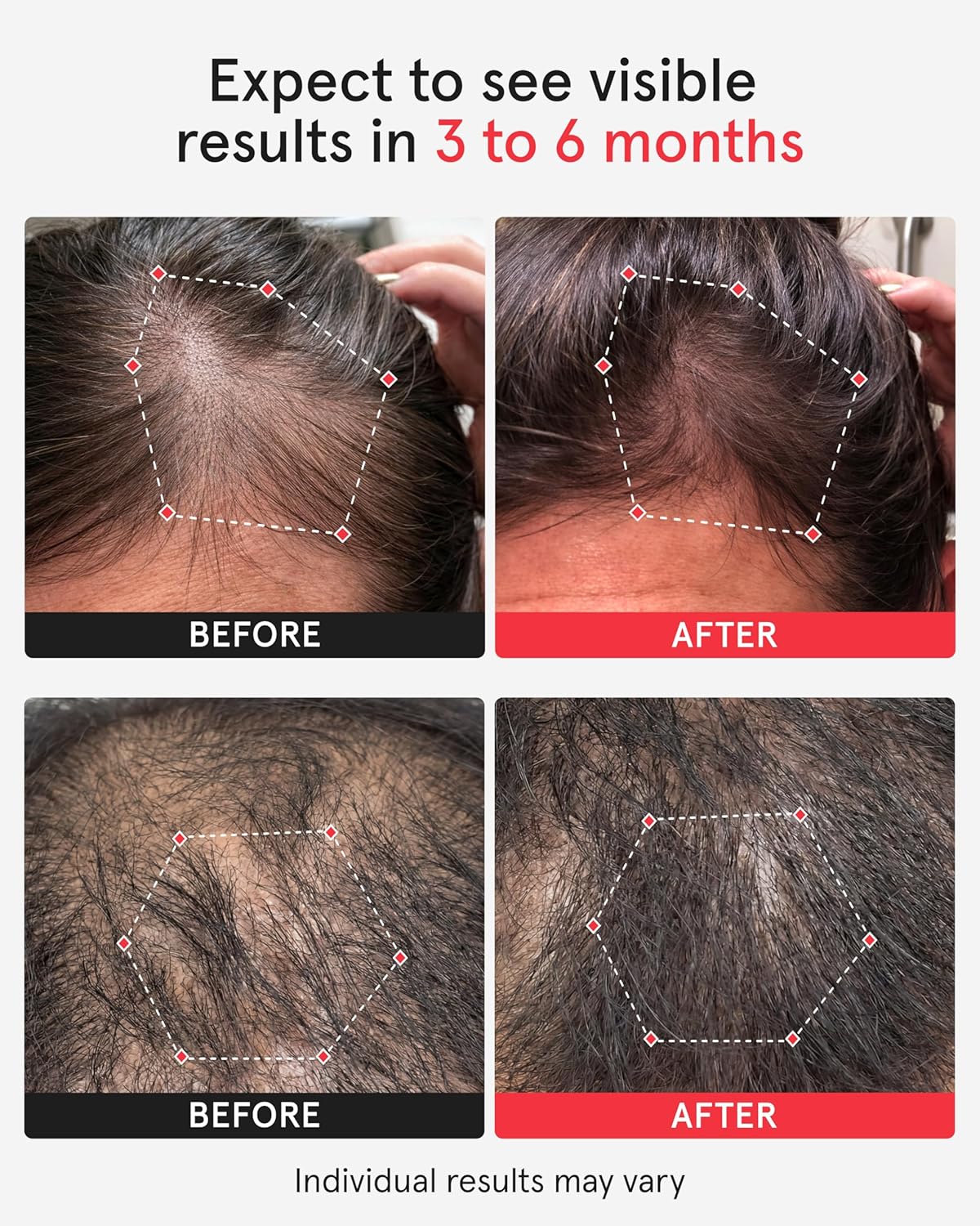 iRestore Professional Laser Red Light Therapy for Hair Growth System - FDA Cleared Hair Loss, Hair Thinning & Alopecia Treatment for Men & Women - 282 Lasers & LEDs